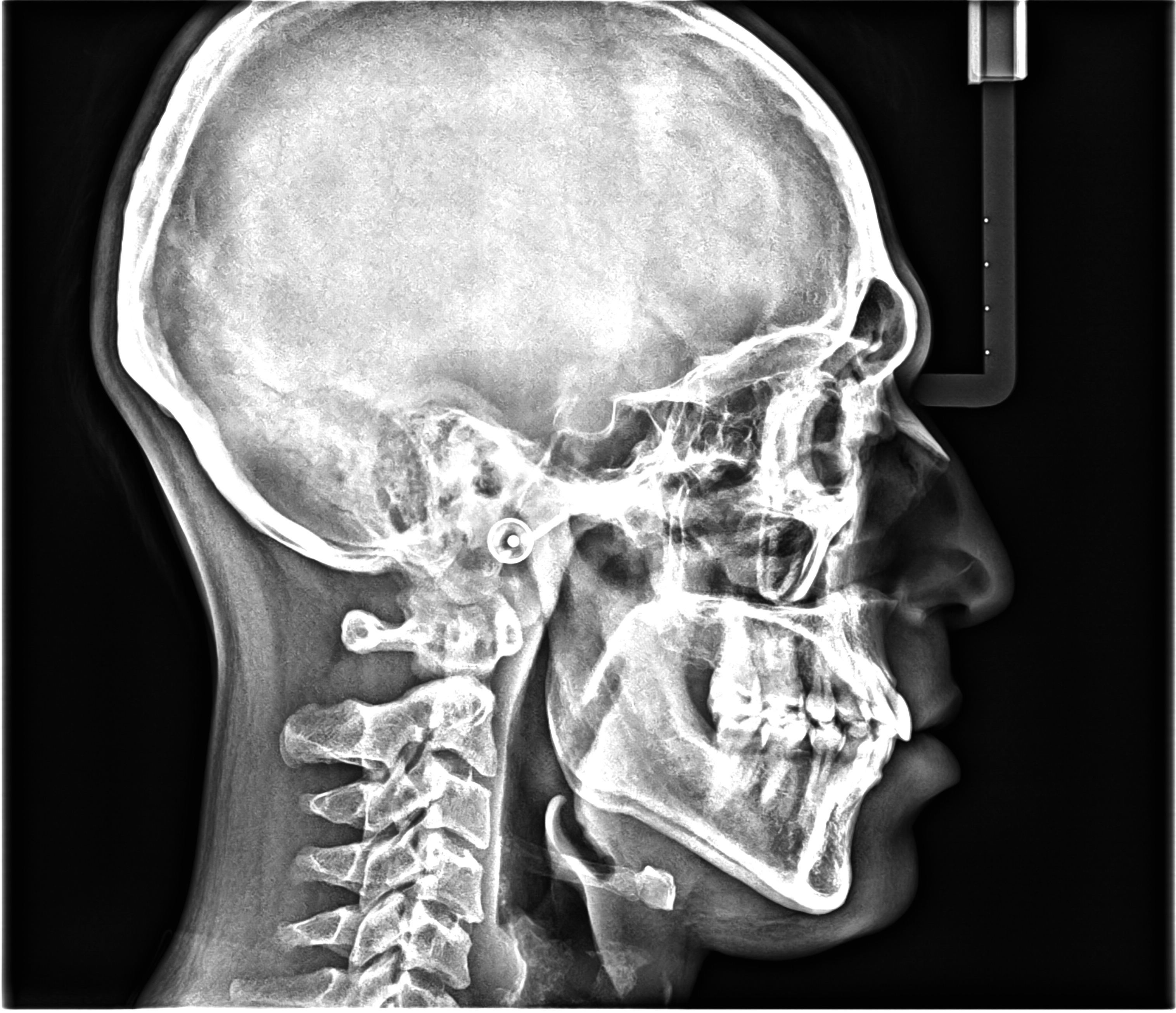 Cephalometric Analysis