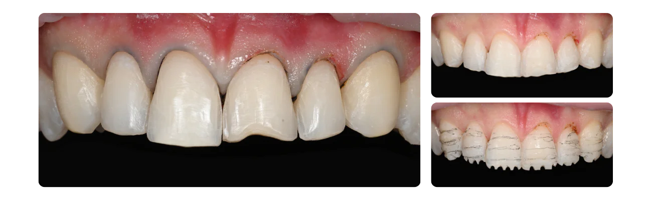 Preparatie - Diagnostische Wax-up
